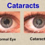 Cataract Treatment