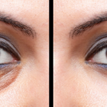 Oculoplastic Surgery